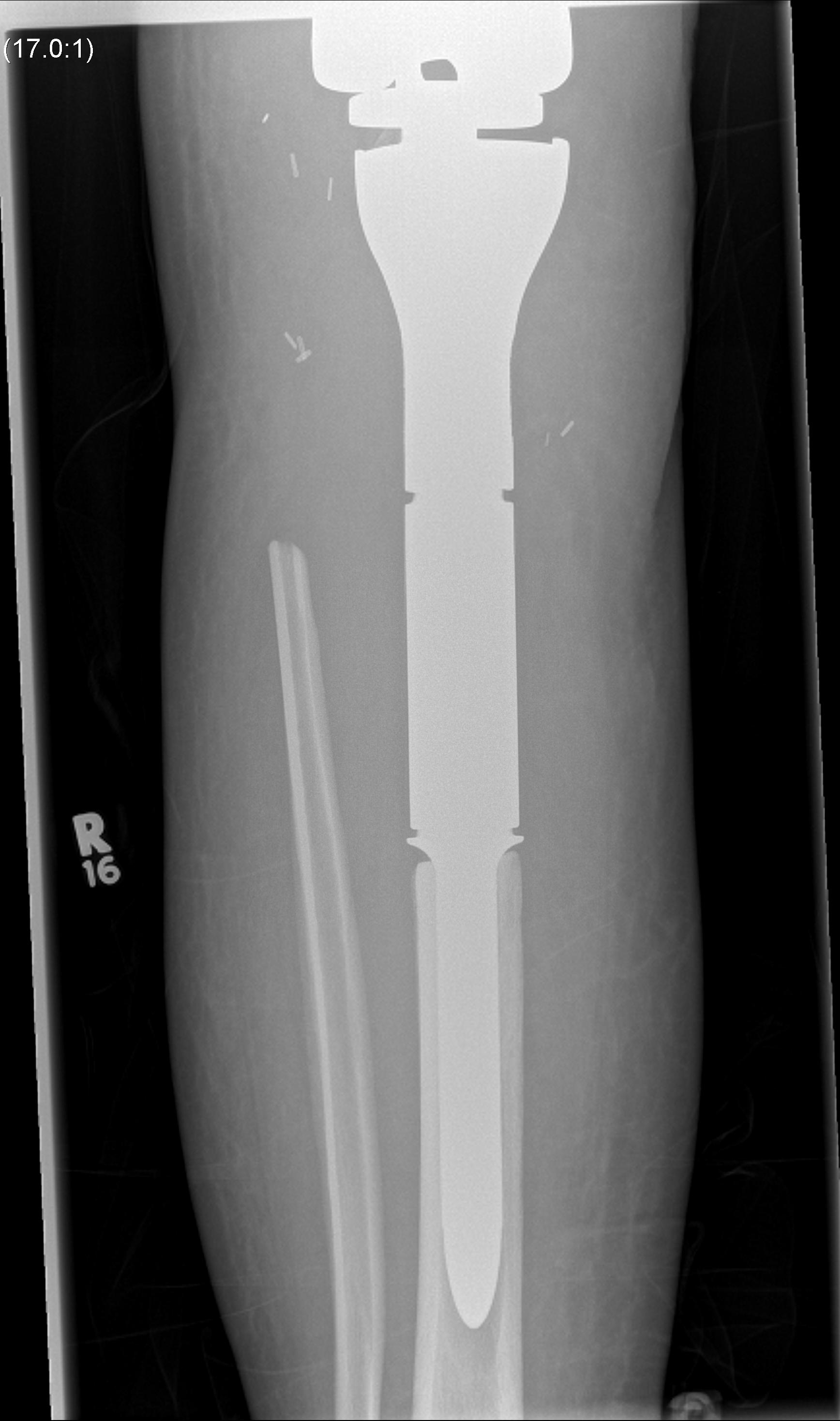 Osteosarcoma Proximal Tibial Resection0001